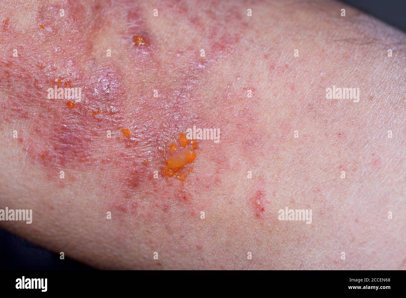Extreme close-up photography of the atopic dermatitis symptoms on  the left elbow pit of an adult male in a very advance stage. Stock Photo