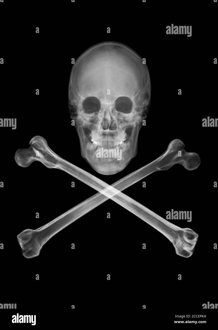 Skull and crossbones, X-ray Stock Photo