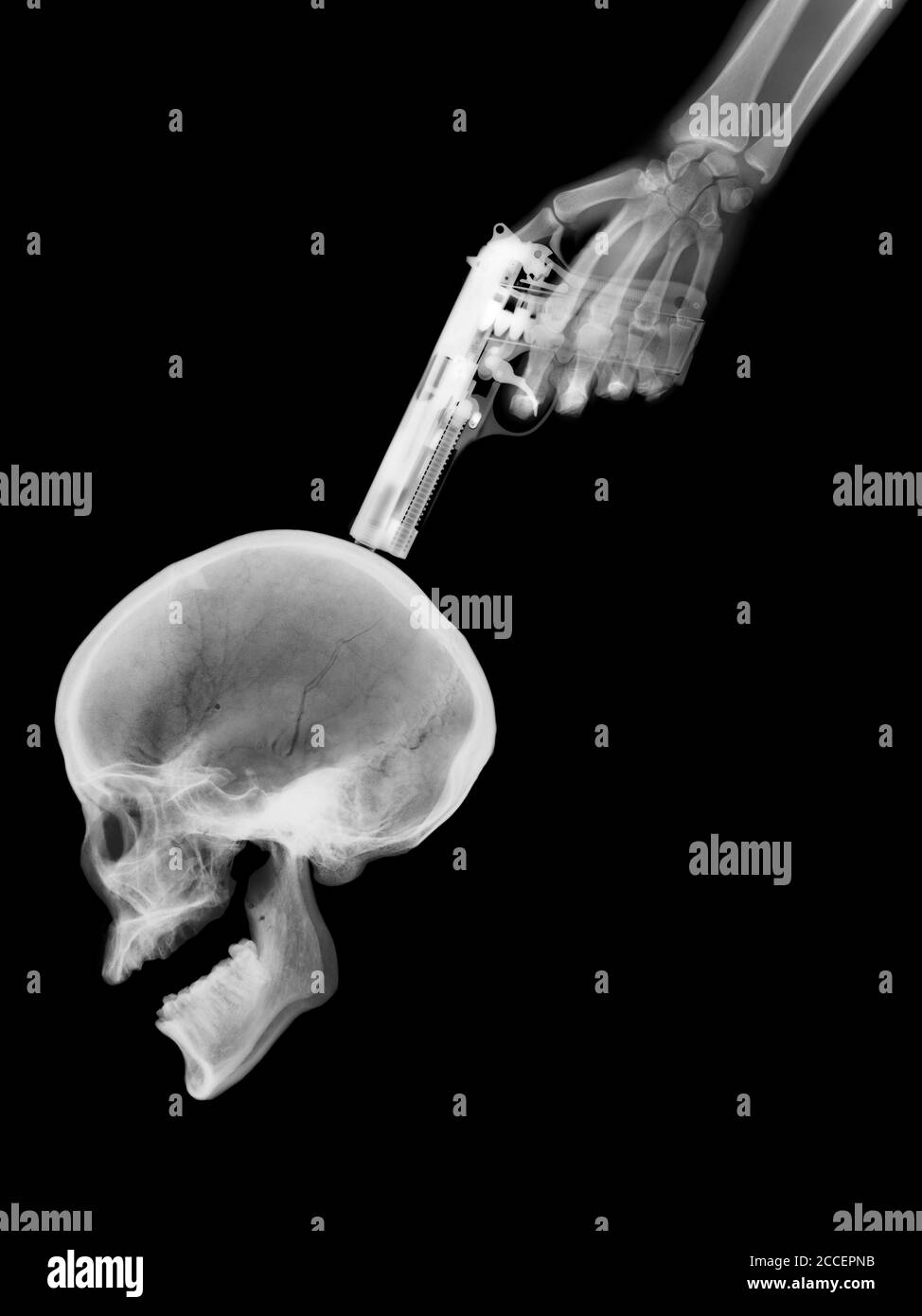 Gun to skull, X-ray Stock Photo