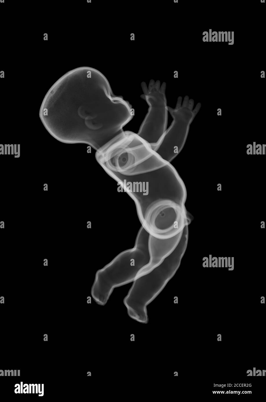 Plastic baby doll toy, X-ray Stock Photo