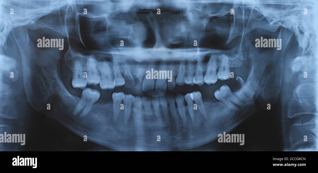 Panoramic dental and mandible xray image Stock Photo Alamy