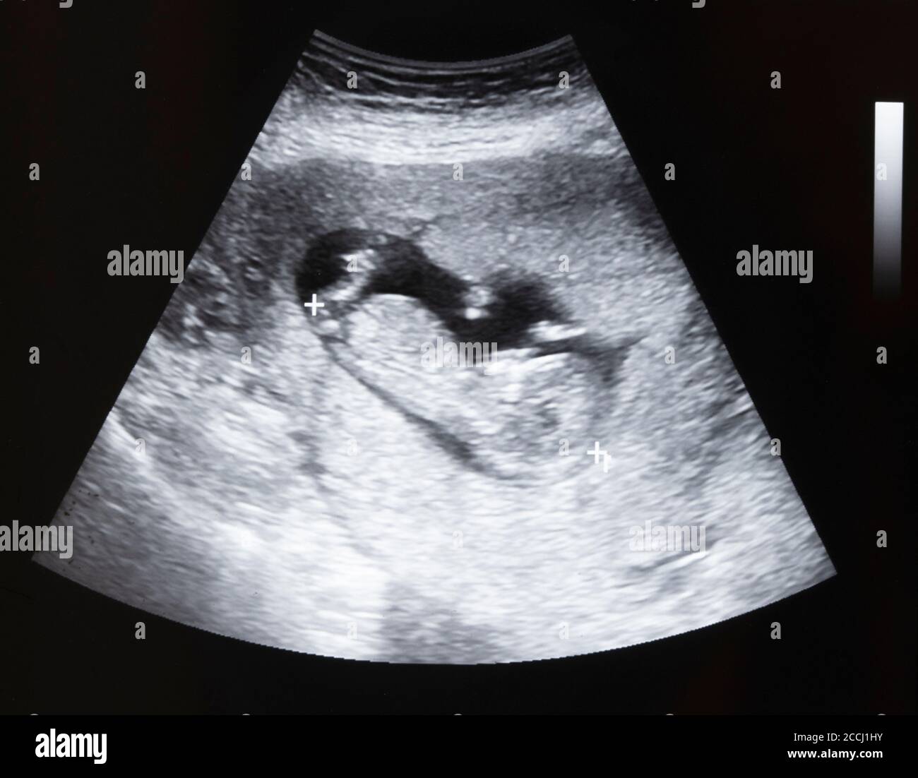 Ultra sound and baby hi-res stock photography and images - Alamy