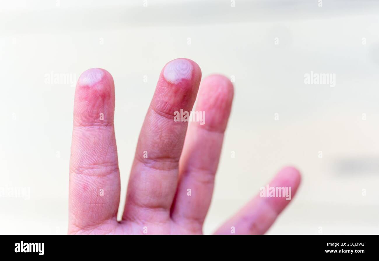 blister on children finger caused by hot water injury Stock Photo Alamy