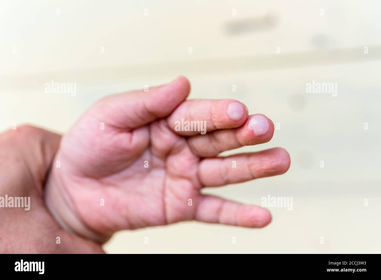blister on children finger caused by hot water injury Stock Photo Alamy