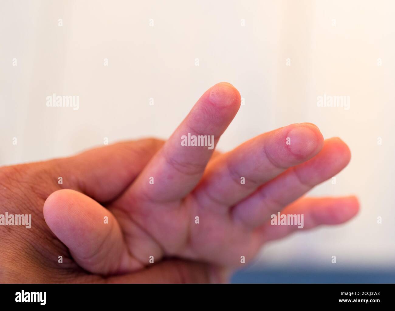 blister on children finger caused by hot water injury Stock Photo Alamy