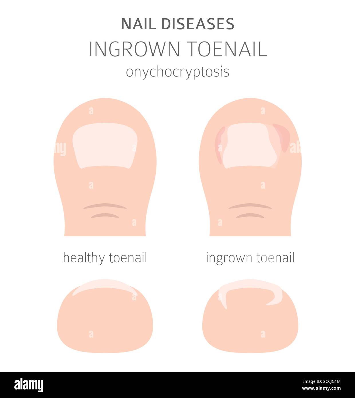 Toenail Health: 5 Signs of Issues and What They Mean | Elizabeth E. Auger,  DPM
