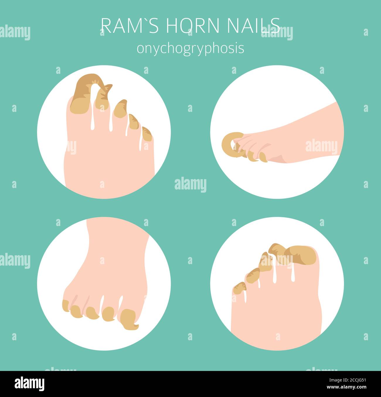Thickening nail Stock Vector Images - Alamy