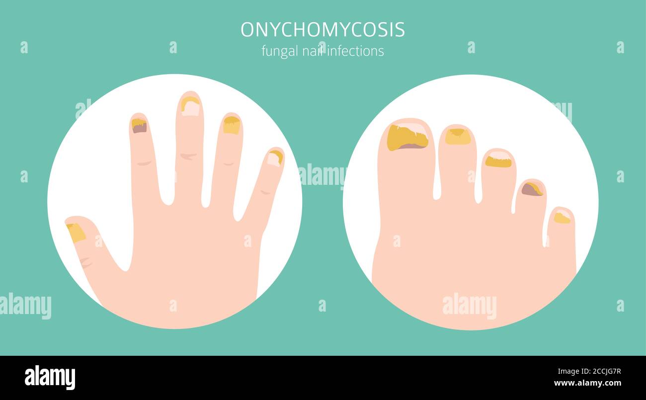 Nail diseases. Onychomycosis, nail fungal infection causes, treatment icon set. Medical infographic design.  Vector illustration Stock Vector