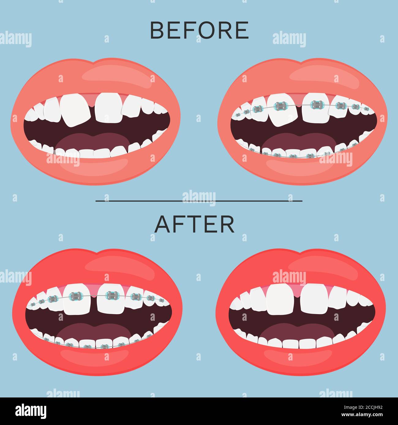 Open mouth, teeth with brace correction before and after vector