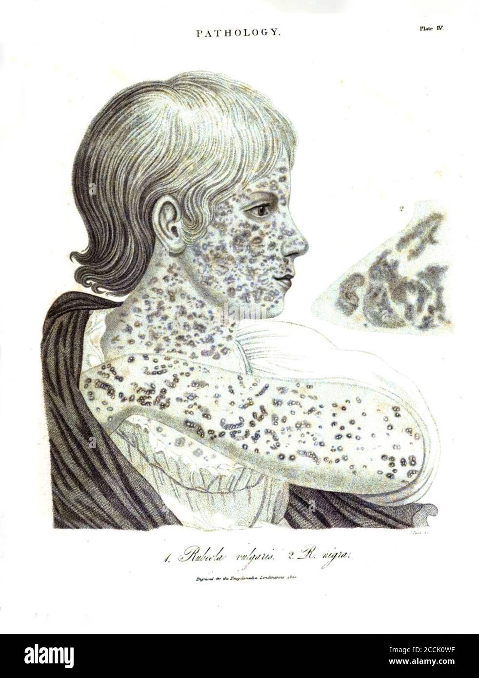 Illustration of a pathological skin disease caused by Rubeola measles From the Encyclopaedia Londinensis or, Universal dictionary of arts, sciences, and literature; Volume XIX;  Edited by Wilkes, John. Published in London in 1823 Stock Photo