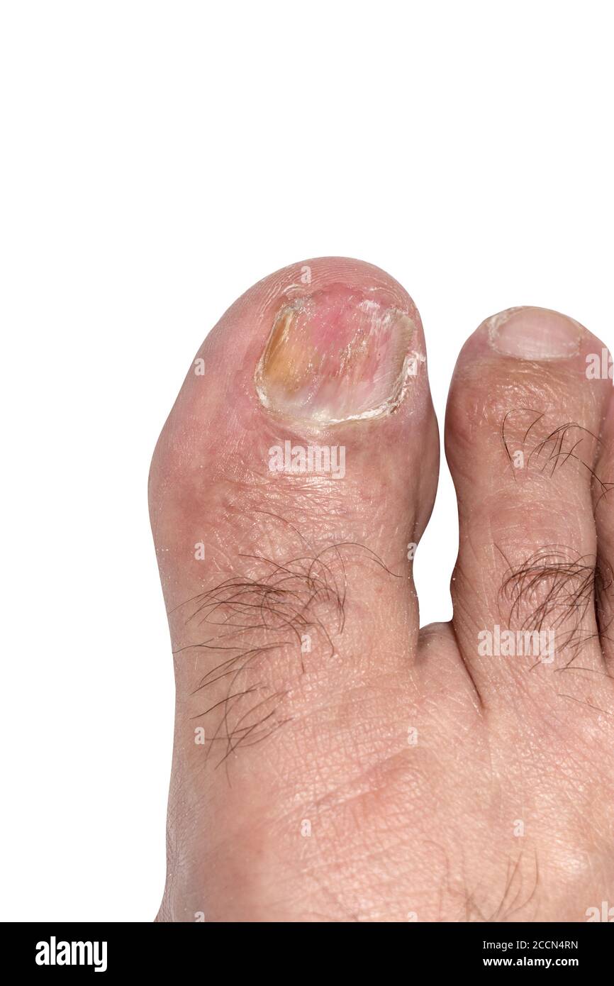 View of a big toe nail infected with toe fungus after lacque polish