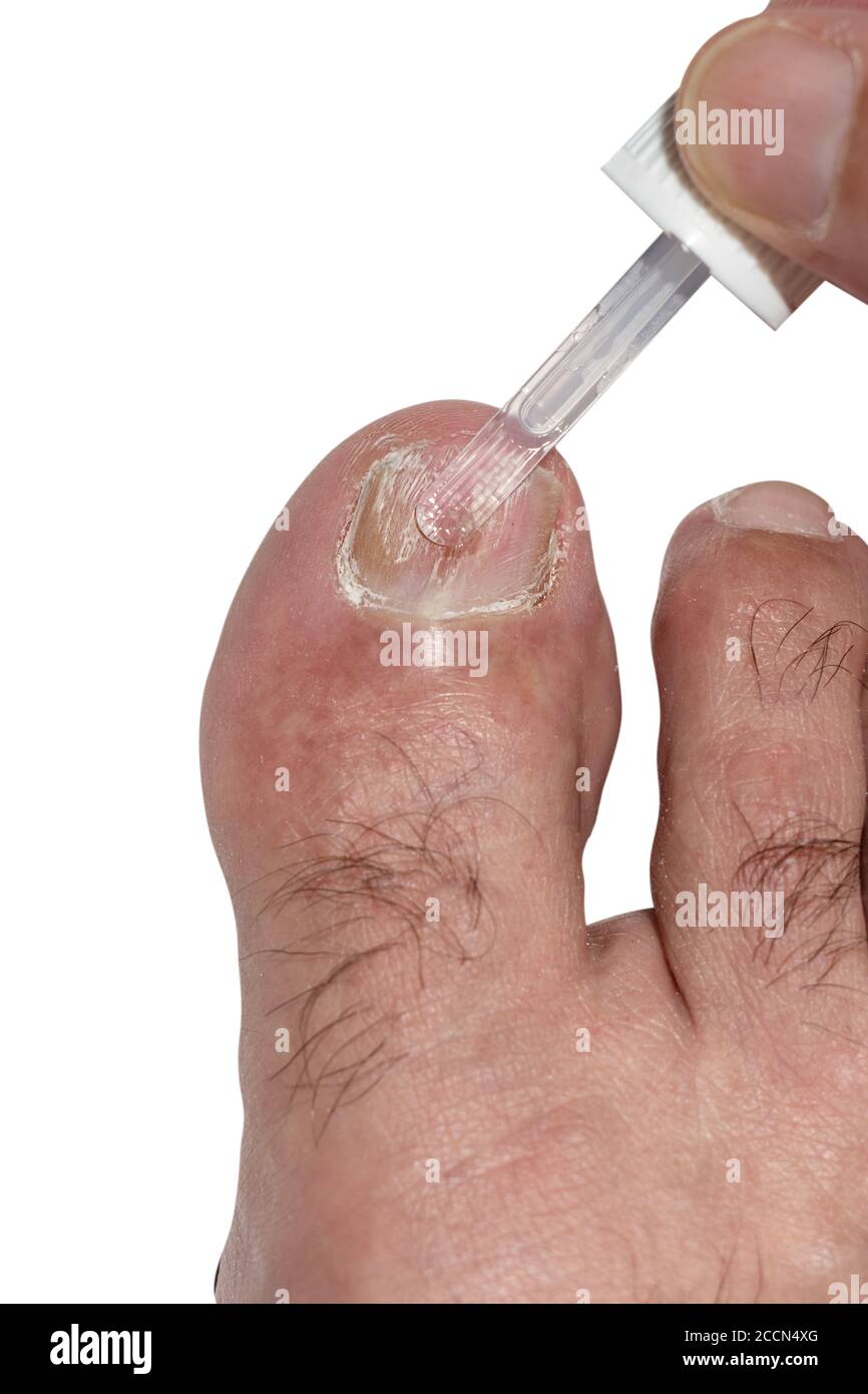 Hand applying antifungal polish to a big toe nail affected with toe