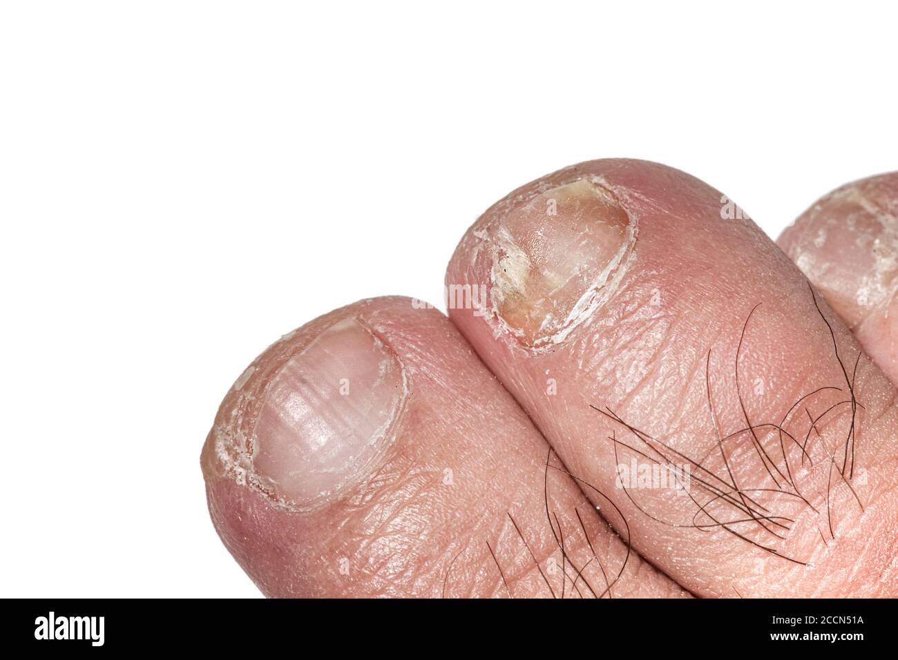 Macro photography of toe nails infected with Onychomycosis. Stock Photo