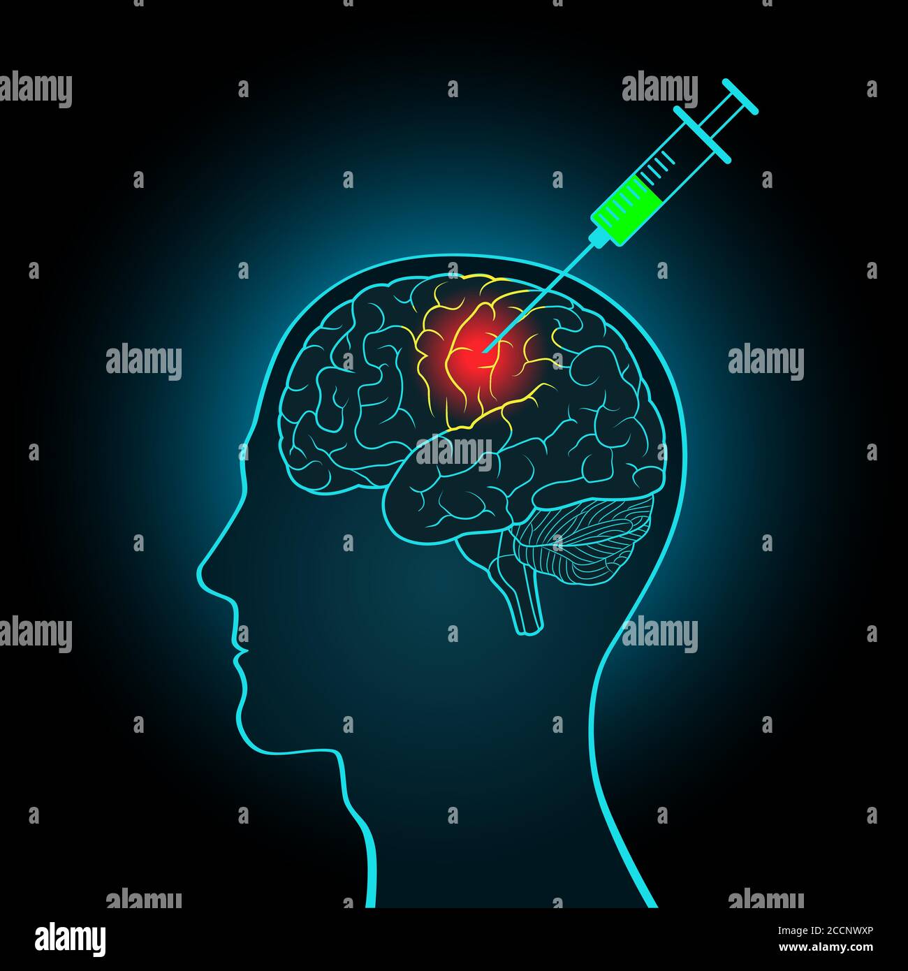 The injection syringe to the brain, the concept of direct treatment of brain tumors and other diseases. Concept of treating diseases of the brain Stock Vector