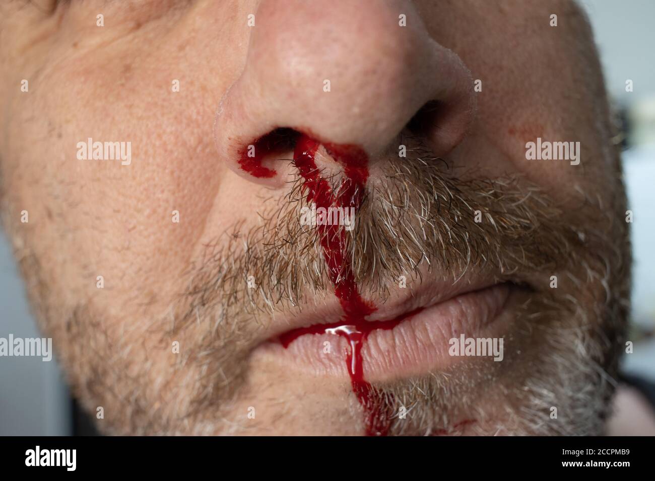 nosebleed , A man is bleeding from his nose Stock Photo