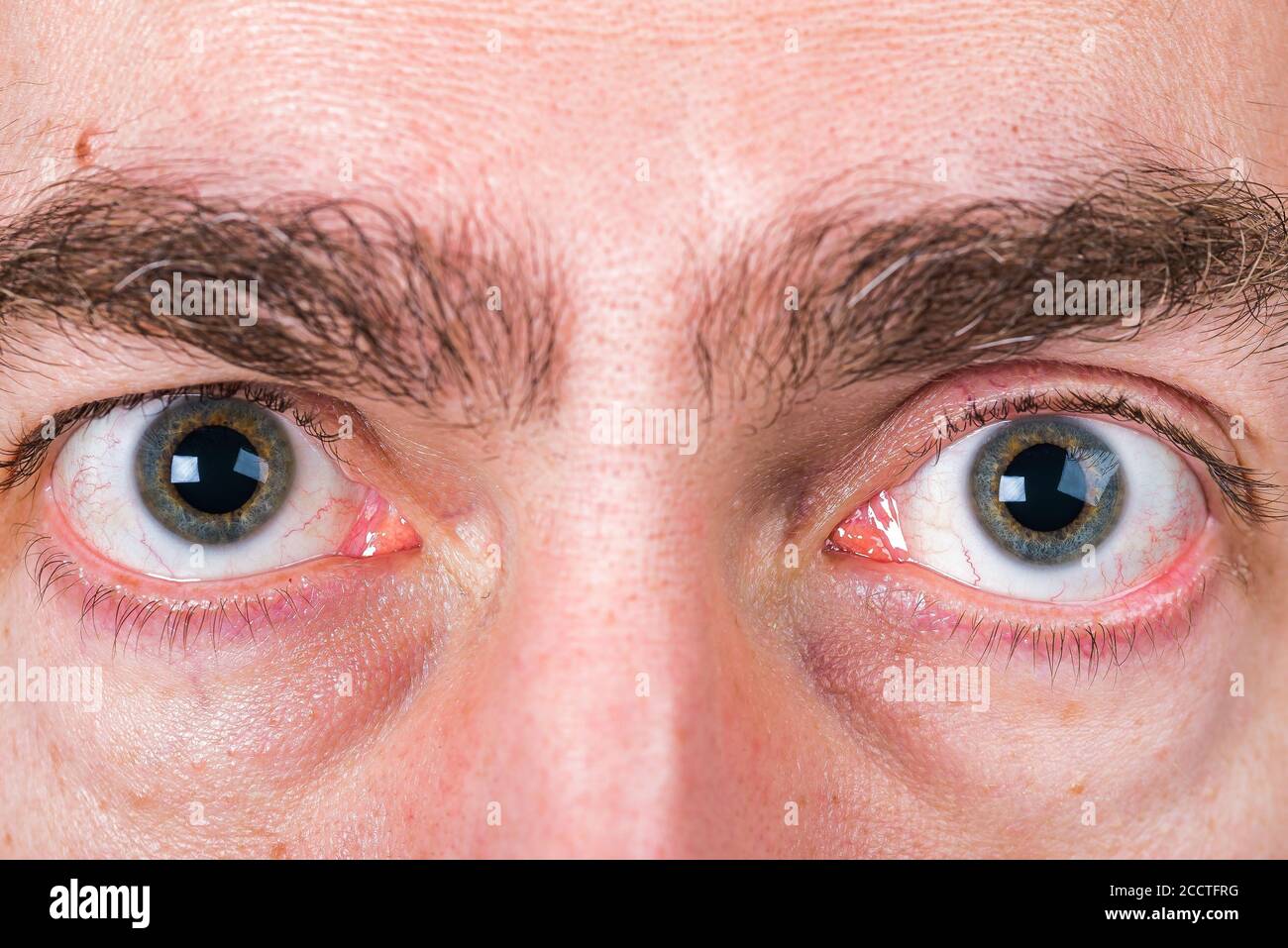 Big eyes of man with light skin and strong eyebrow and circles under eyes Stock Photo
