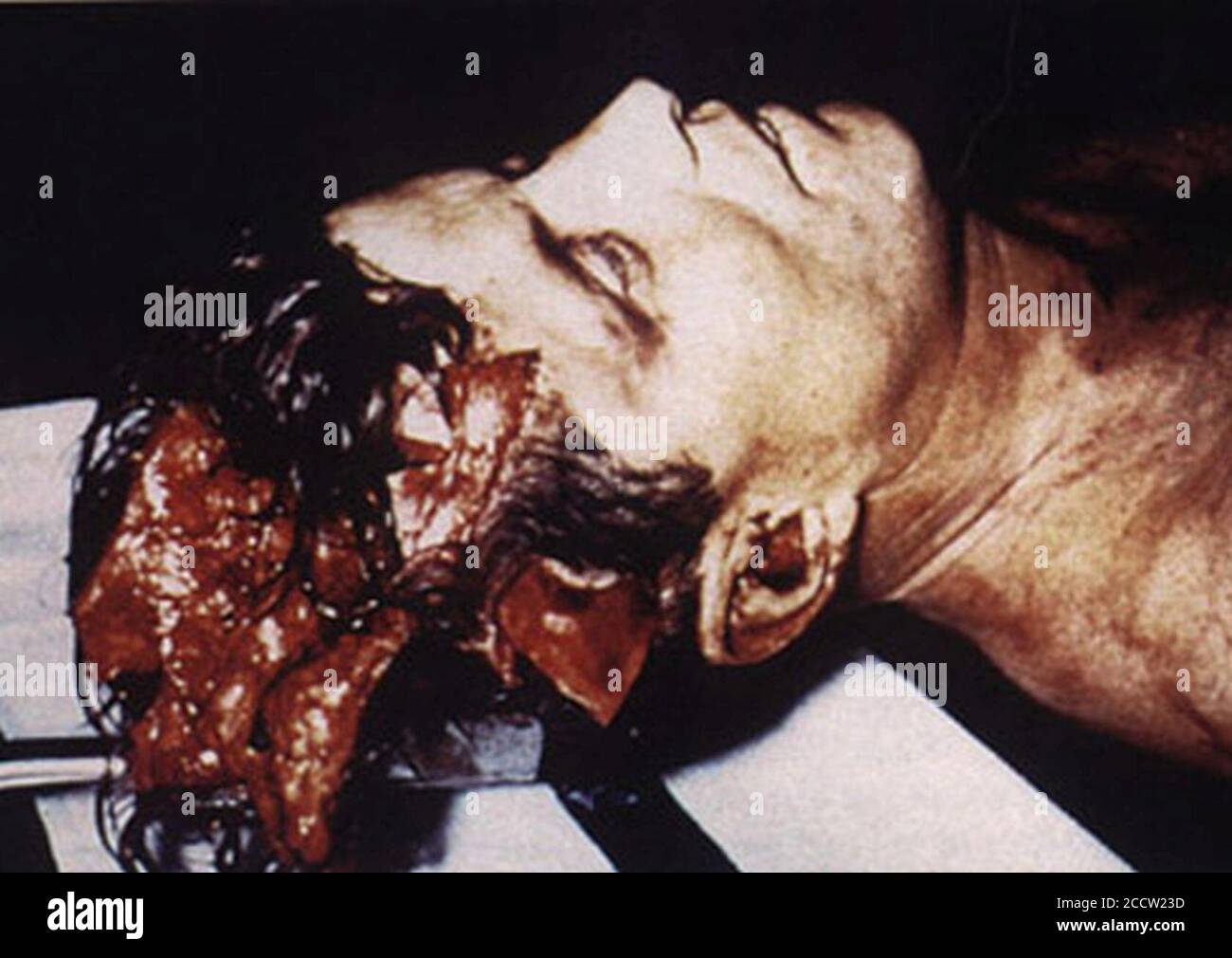 JFK autopsy. Stock Photo