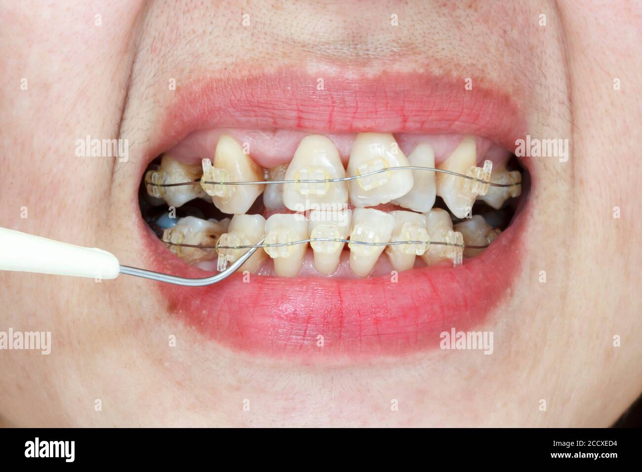 Closeup mouth of crooked teeth with braces and plaque remover Stock