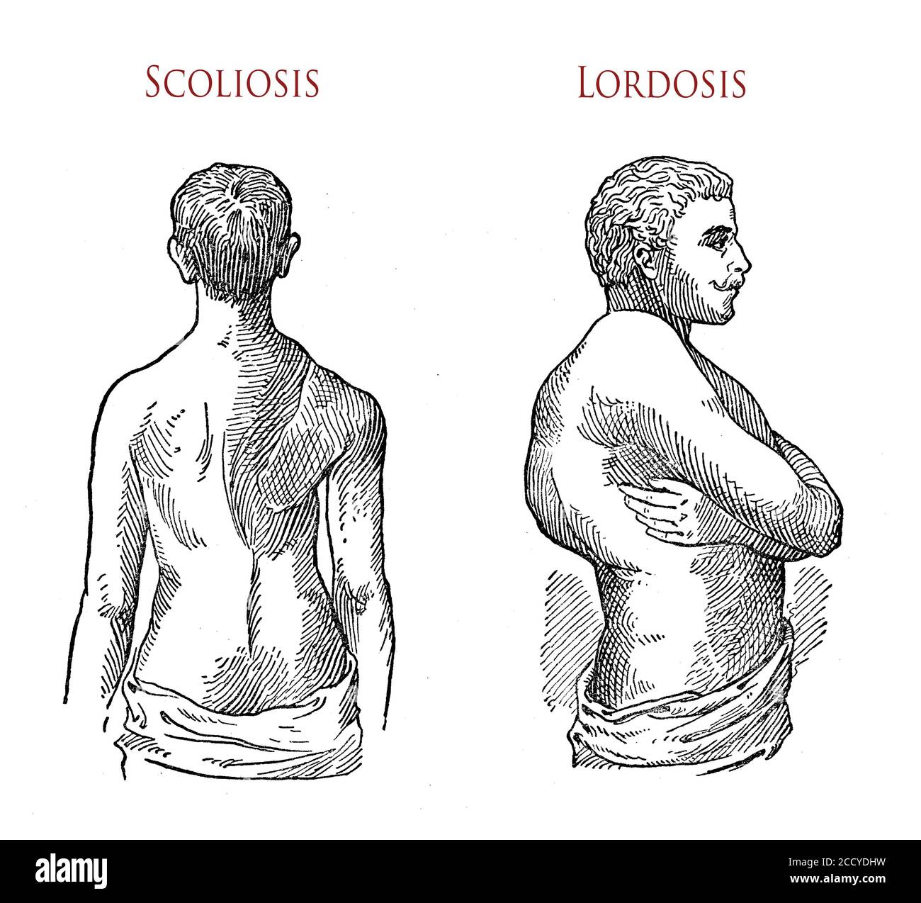 Healthcare and orthopedics: male patients affected by scoliosis (person's spine with a sideways curve) and lordosis (abnormal inward or swayback curvature of the lumbar spine) Stock Photo