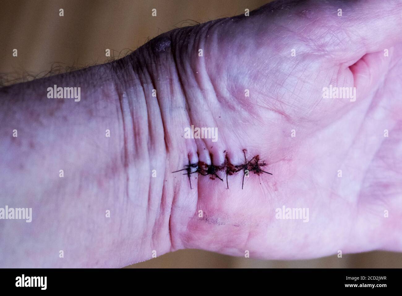 Stitches in a hand after a carpal tunnel operation Stock Photo