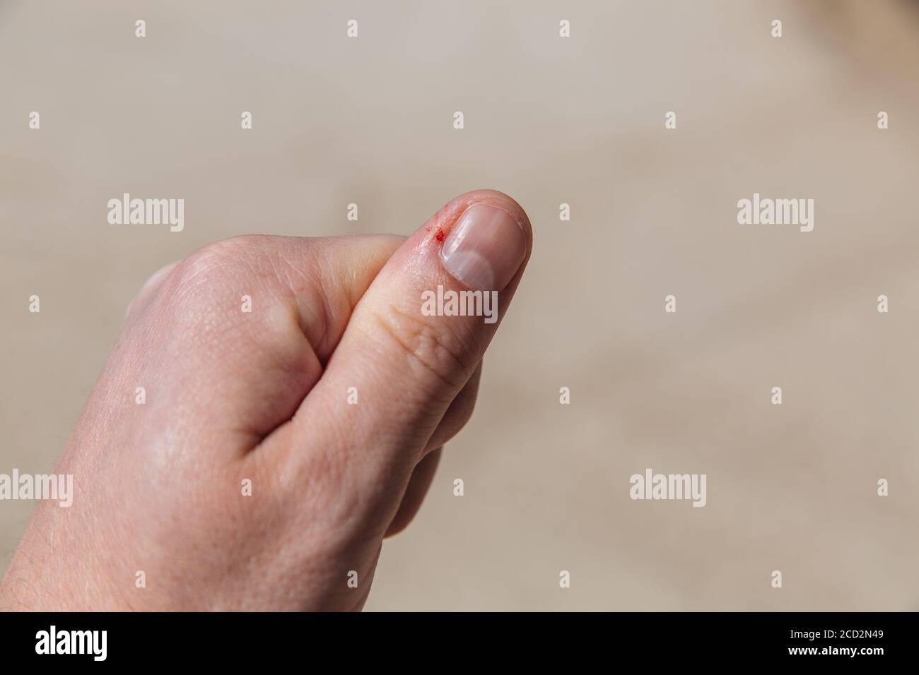 Thumb trauma. Bleeding from a cut finger. Blood from a finger. Stock Photo