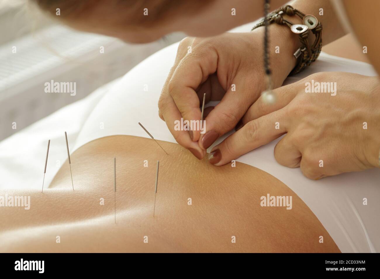 Alternative medicine. Master is injecting steel needles during procedure of acupuncture therapy. Stock Photo