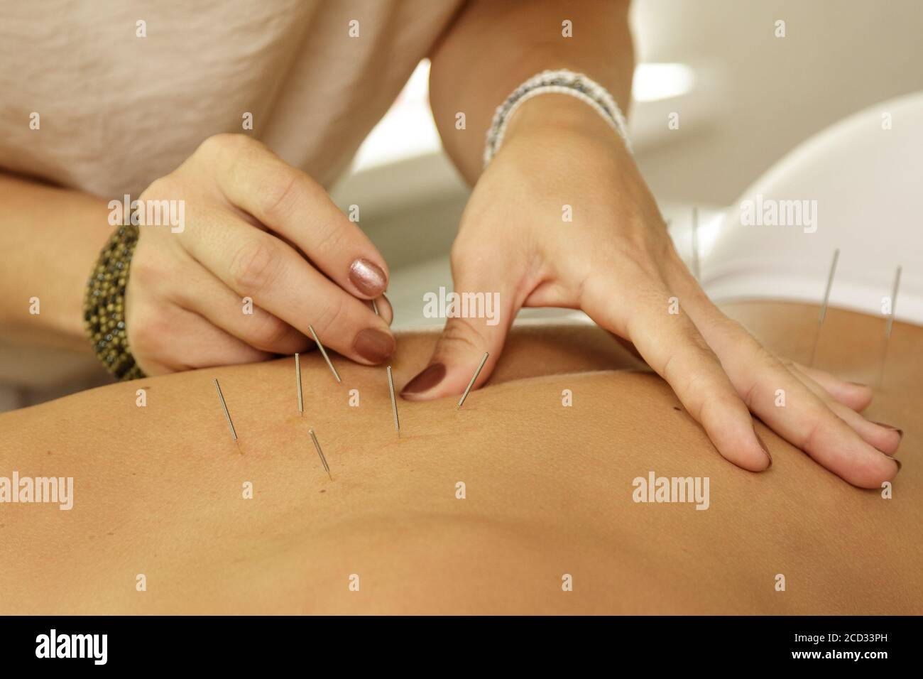 Alternative medicine. Master is injecting steel needles during procedure of acupuncture therapy. Stock Photo