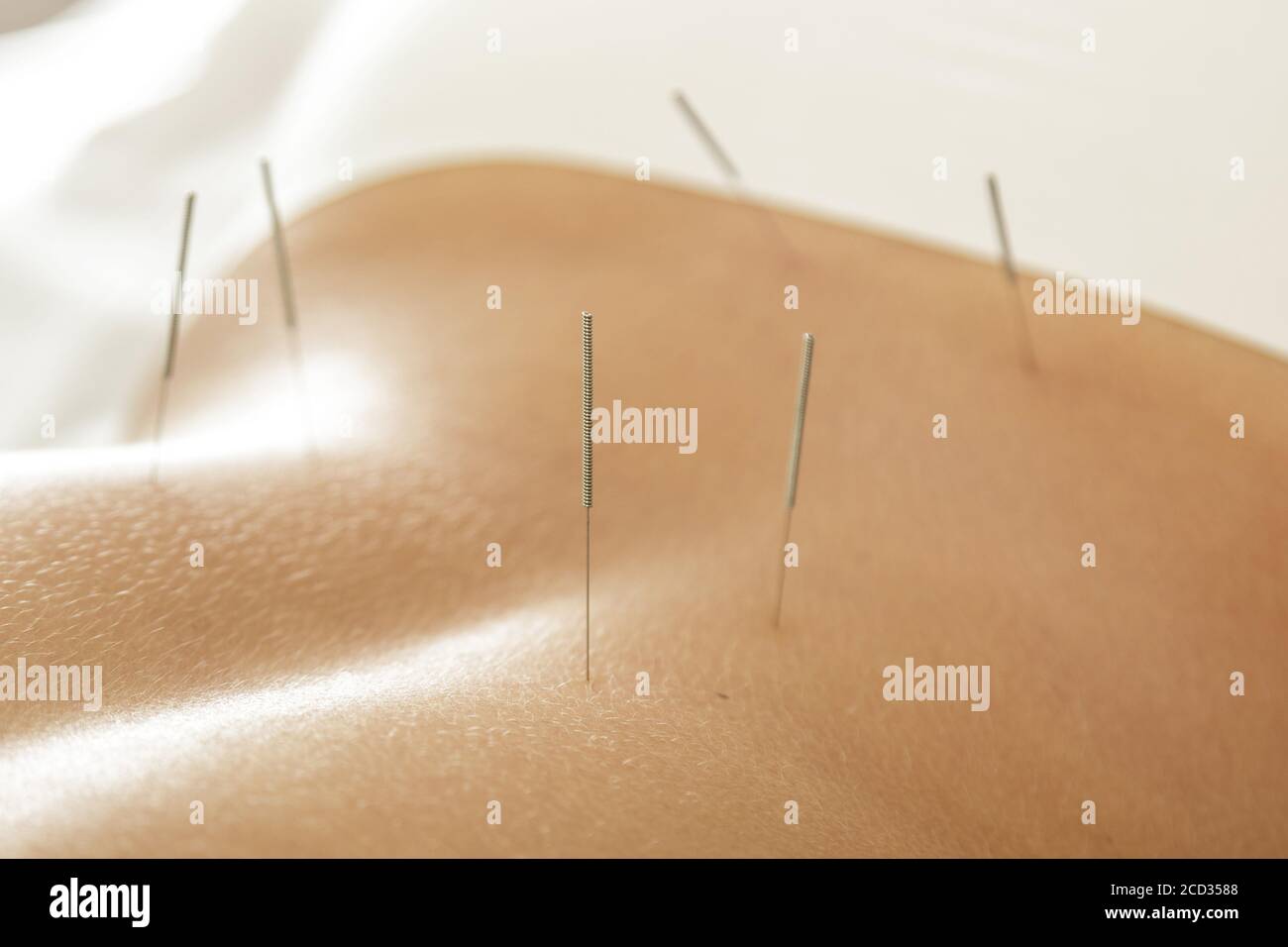 Alternative medicine. Close-up of female back with steel needles during procedure of acupuncture therapy. Stock Photo