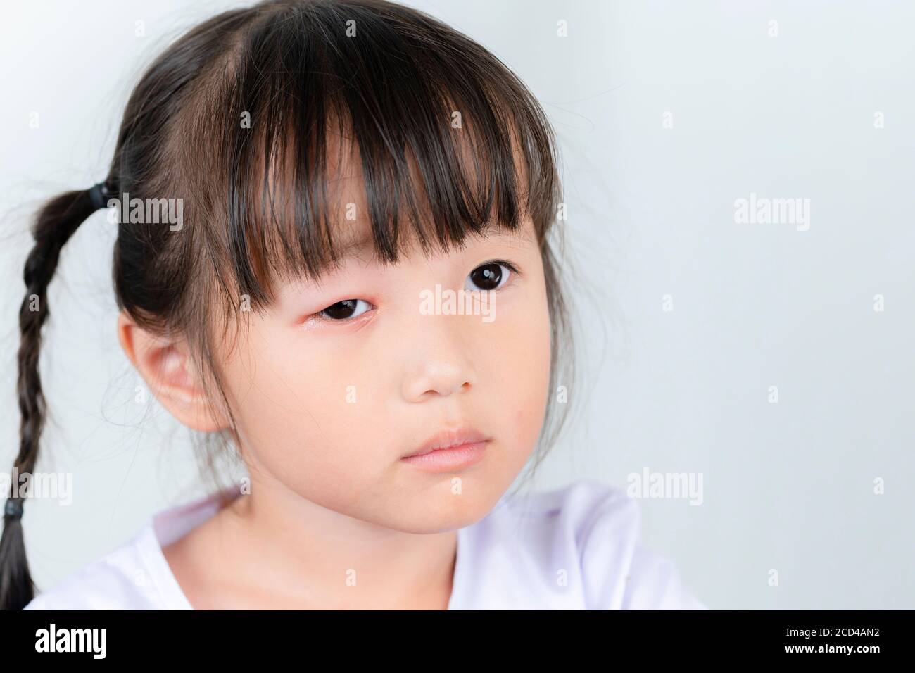 Asian girl with red pink eye inflammation blepharitis from allergy Stock Photo