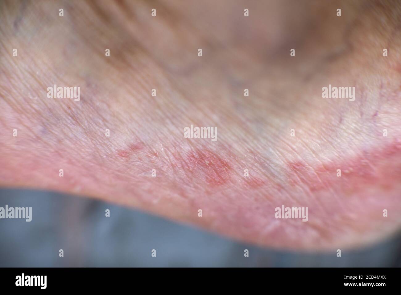Athlete's foot, known medically as tinea pedis,  is a common skin infection of the feet caused by fungus. Stock Photo