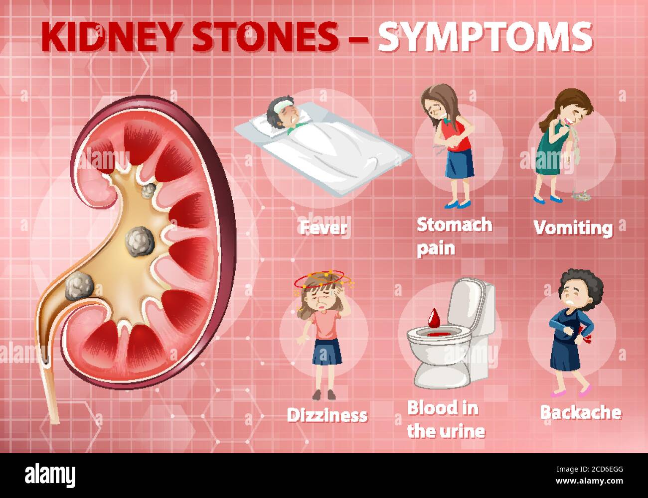 Kidney stones symptoms cartoon style infographic illustration Stock