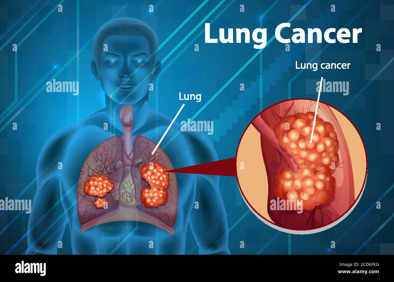 Informative illustration of lung cancer illustration Stock Vector Image ...