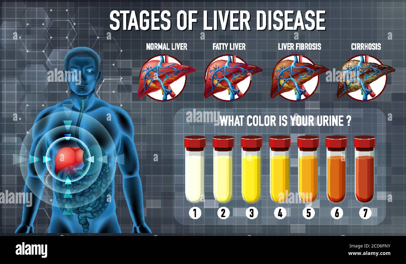 Stages of liver disease illustration Stock Vector Image & Art - Alamy