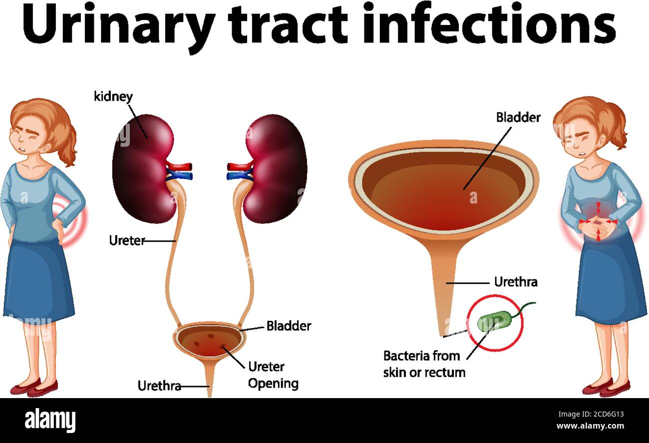 Informative illustration of urinary tract infections illustration Stock Vector