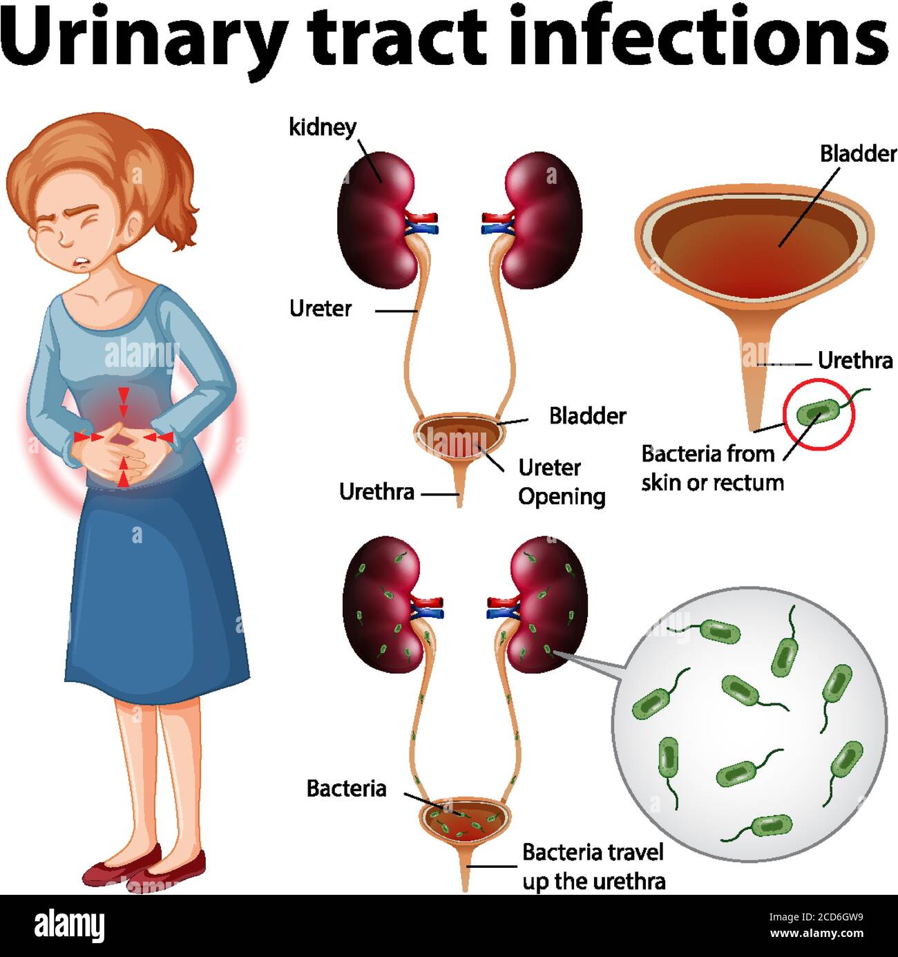 Informative illustration of urinary tract infections illustration Stock Vector