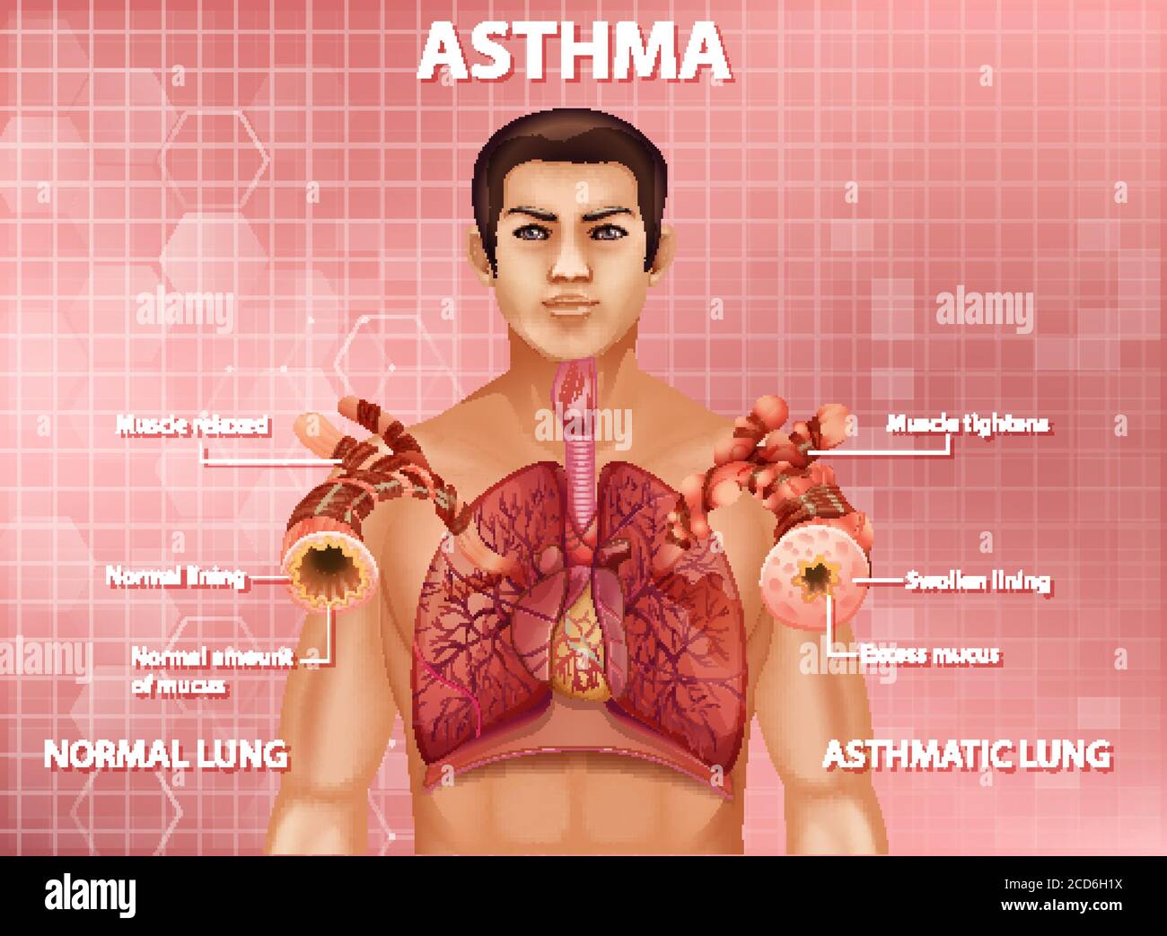 Human anatomy asthma diagram illustration Stock Vector