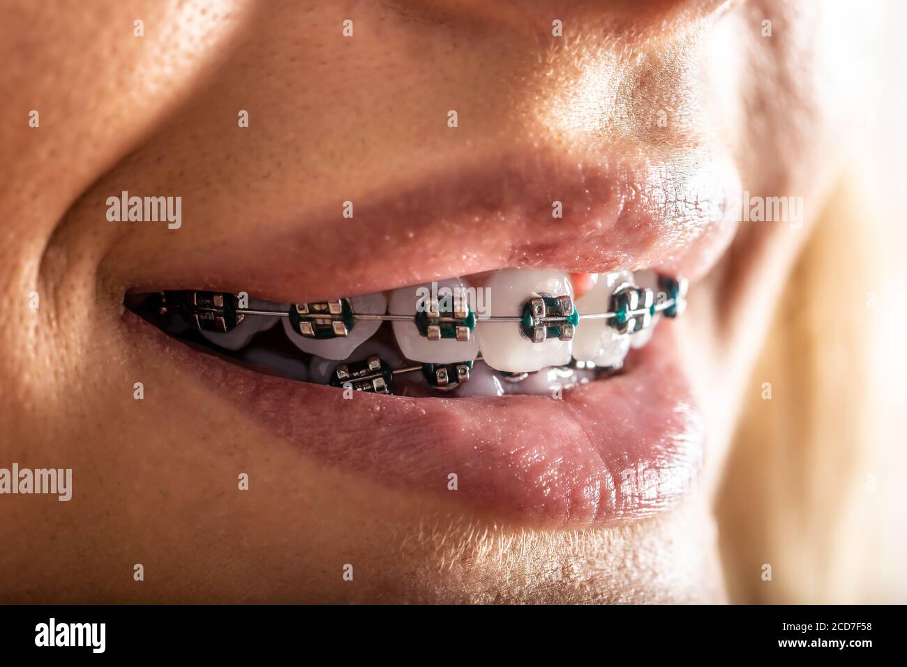 Extreme detail of teeth with a dental braces in the mouth of a young