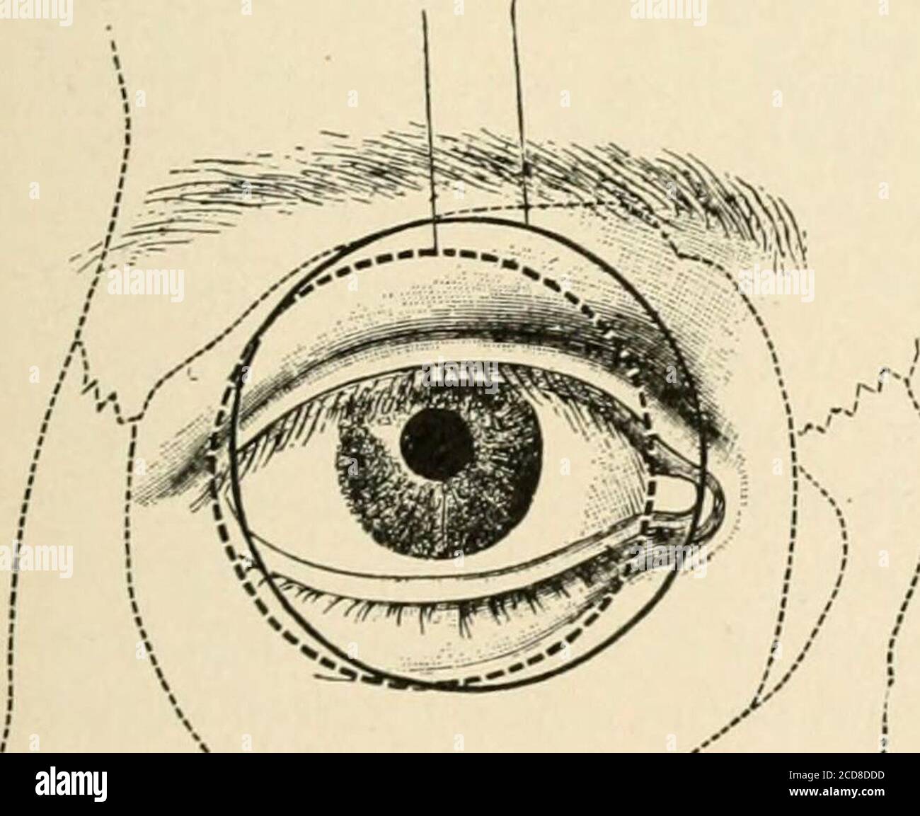 . A treatise on diseases of the eye . Nerves of tlie Oibit and Ophthalmic Ganglion, side view. (Gray.) EYELIDS 43 Fig. 19 narily wide open, from 8 to 14 mm; it frequently Varies in width in thetwo eyes. Temporally the lids approach each other at a sharp angle,forming the external canthus. When the lids are separated, a delicate,thin membrane stretches acrossthis angle, forming the externalcommissure. At the inner angle ofthe lids, internal canthus, the pal-pebral fissure is horseshoe in shape,the ends of the shoe correspondingto the puncta lachrymalia. Puncta Lachrymalia.—The punctalachrymalia Stock Photo