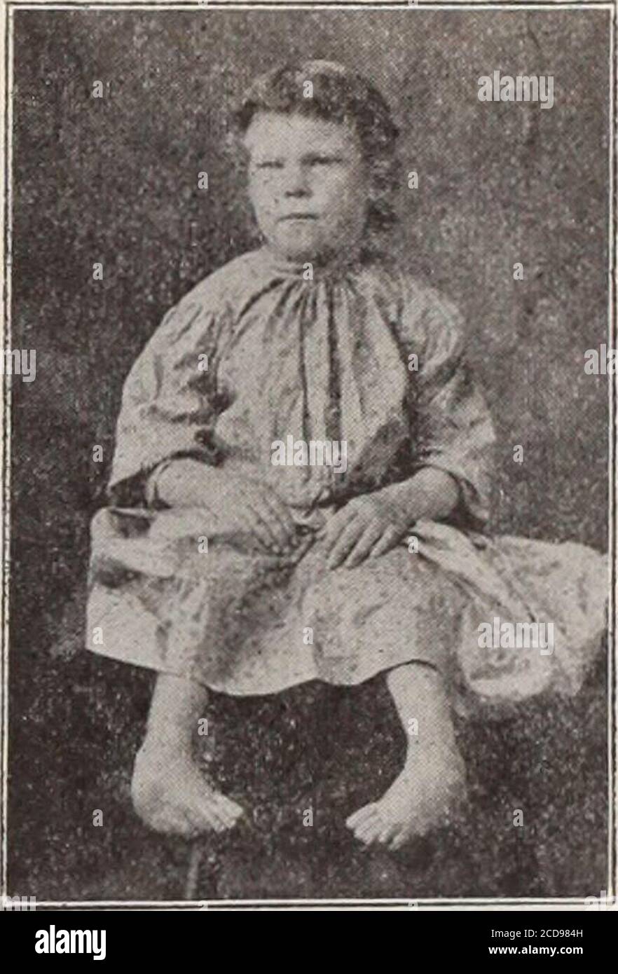 Clubfoot Treatment High Resolution Stock Photography And Images Alamy