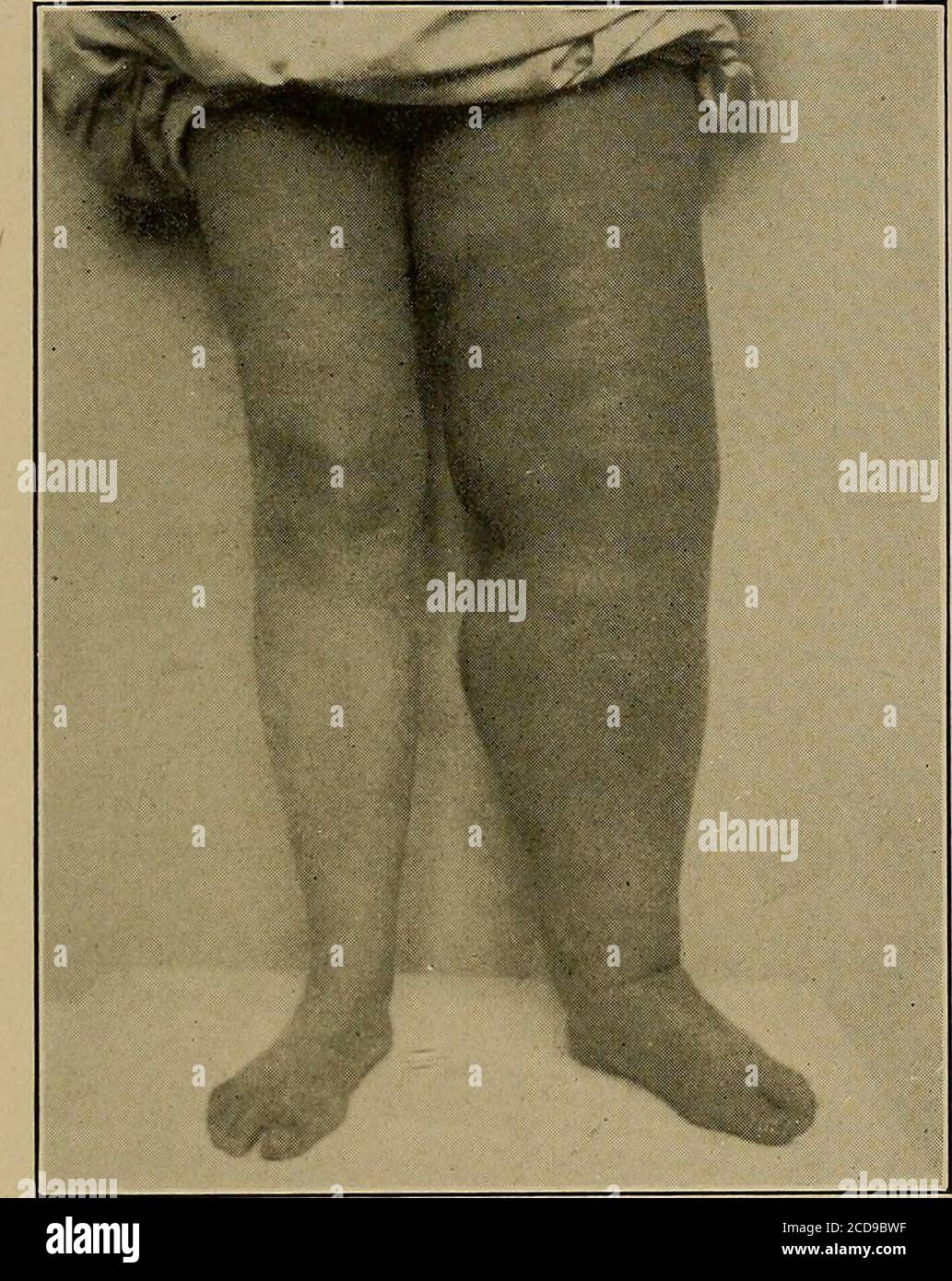 Physical diagnosis . Fig. 237.—Sporadic elephantiasis. (Non-filarial. oedema  depends on the history and the examination of the rest ofthe body. In one leg  oedema may be due to thrombosis of a