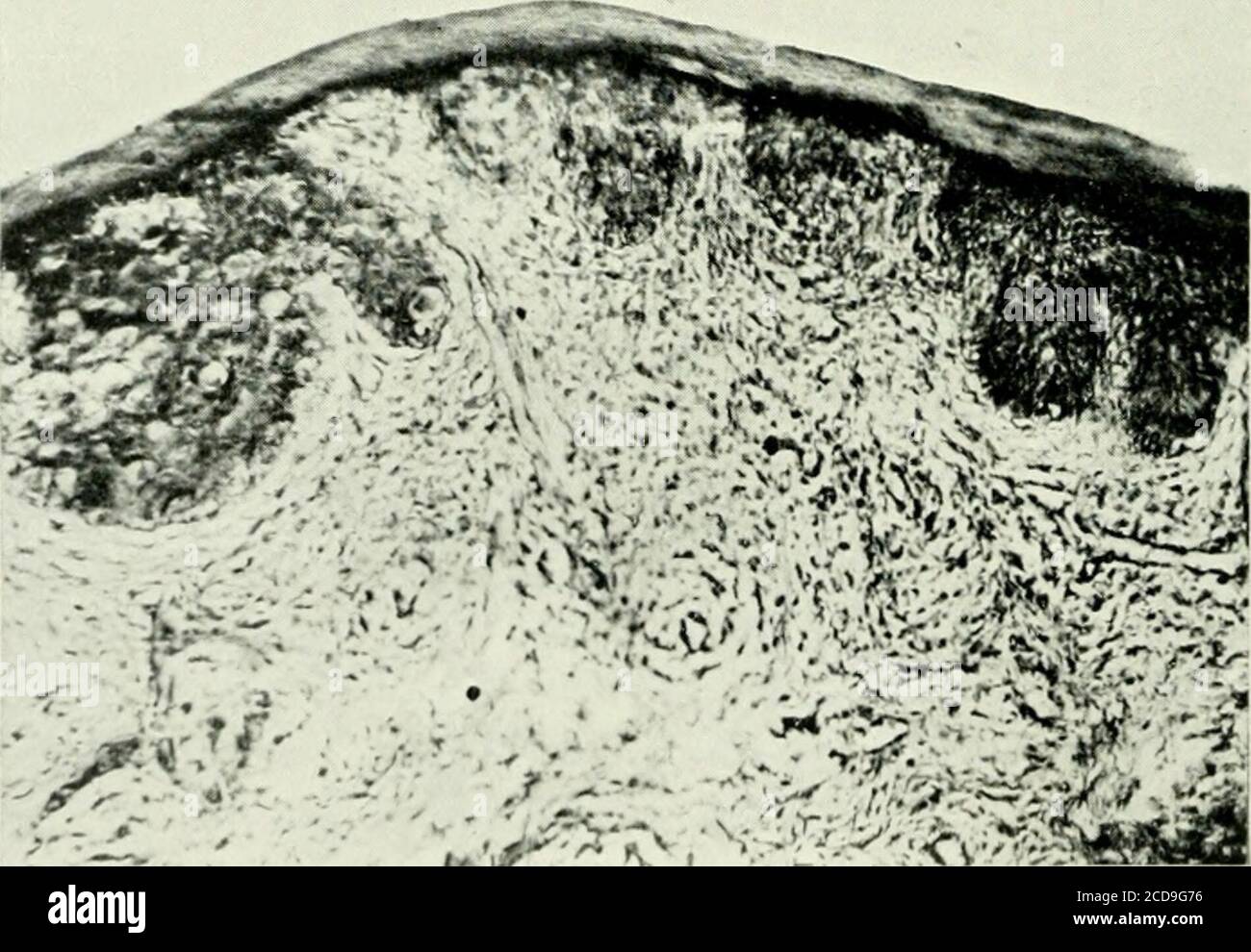 Pagets disease of the nipple hires stock photography and images Alamy