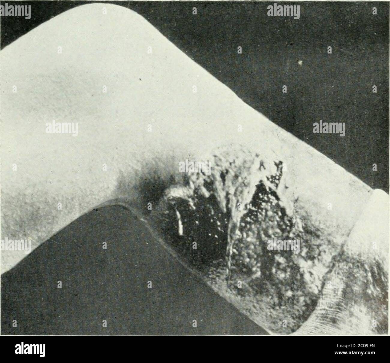 . The British journal of dermatology . Fig. 1.—Shows the cunclitiun ui the left leg in the early p;irt of December,1919 (see text). The ulceration spread from Ijelow upwards, and therecently healed upper edge is well seen. Note the warty projections, whichrepresent the granulations covered bj epithelium. On the lower part ofthe leg and over the outer part of the ankle are seen the scars of olderlesions; here hyperkeratosis has occurred at the edges.. Fig. 2.—Shows the condition of the left leg in January. 1920. Activeulceration has begun again at the upper and inner part of the healed lesionsh Stock Photo