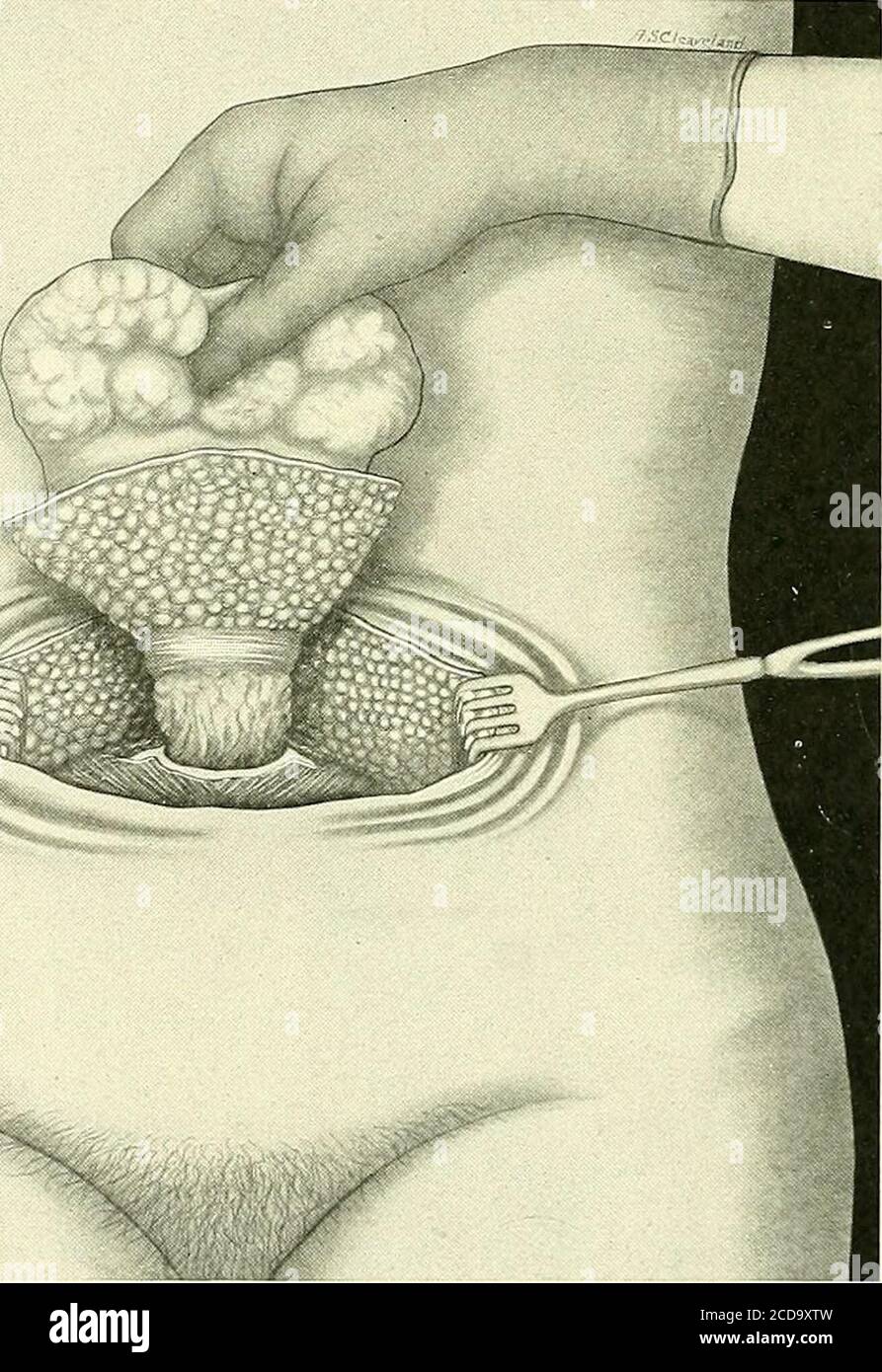 Page 4 Umbilical Hernia High Resolution Stock Photography And Images Alamy