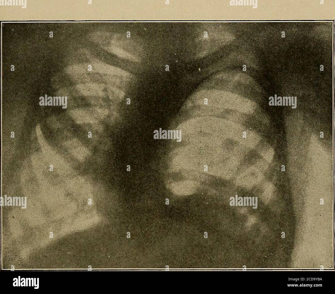 . Physical diagnosis . DISEASES AFFECTING THE PLEURAL CAVITY 313 (b