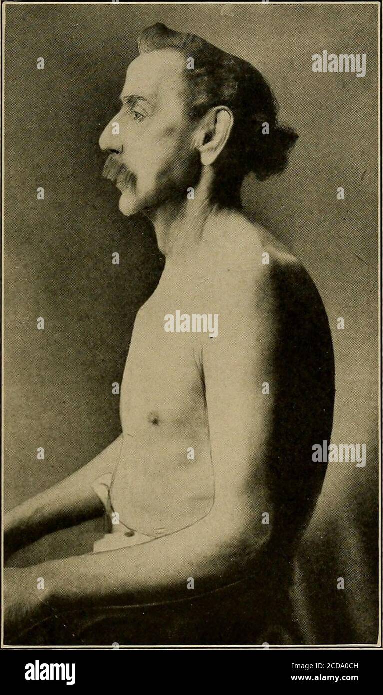 Physical Diagnosis Rominent The Shoulders Are High Andstooping And The Neck Is Short See Fig 1 The Patient Is Oftenconsiderably Cyanosed And His Breathing Rapid And Difficult In Spiration Is Short