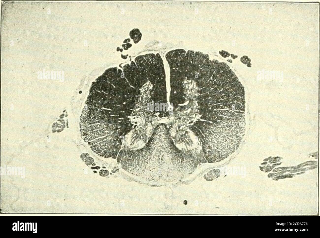 . A text-book of medicine for students and practitioners . Fig. 167 a.— (Cervical cord.). Fig. 107 6.—(Dorsal cord.) the symptoms in Fried-reichs disease, on theone hand, and in tabeson the other; Init weare still greatly in wantof a sufficient numberof careful observations.The ataxia of the ex-tremities evidently de-pends on a degenerationof the posterior columns,and that of the trunkprobably on a degener-ation of the lateral cere- bellar tracts. Thelack of prominenceof other lateral tractsymptoms (with theexception of the Ba-binski [and Oppen-heim] reflexes) hasbeen already om])lia-sized. Th Stock Photo