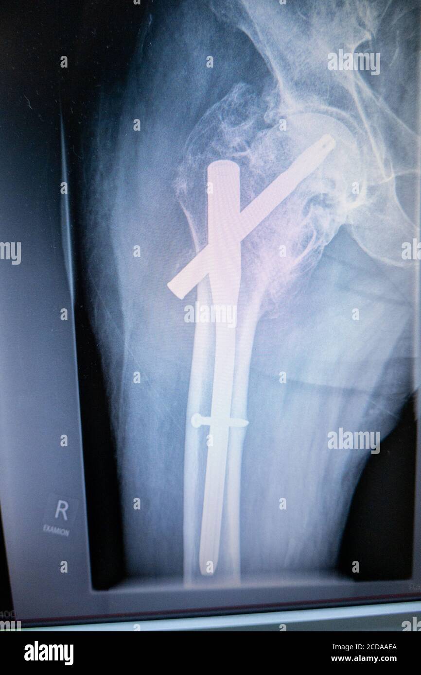 an X-ray of a hip with an implanted femoral nail Stock Photo
