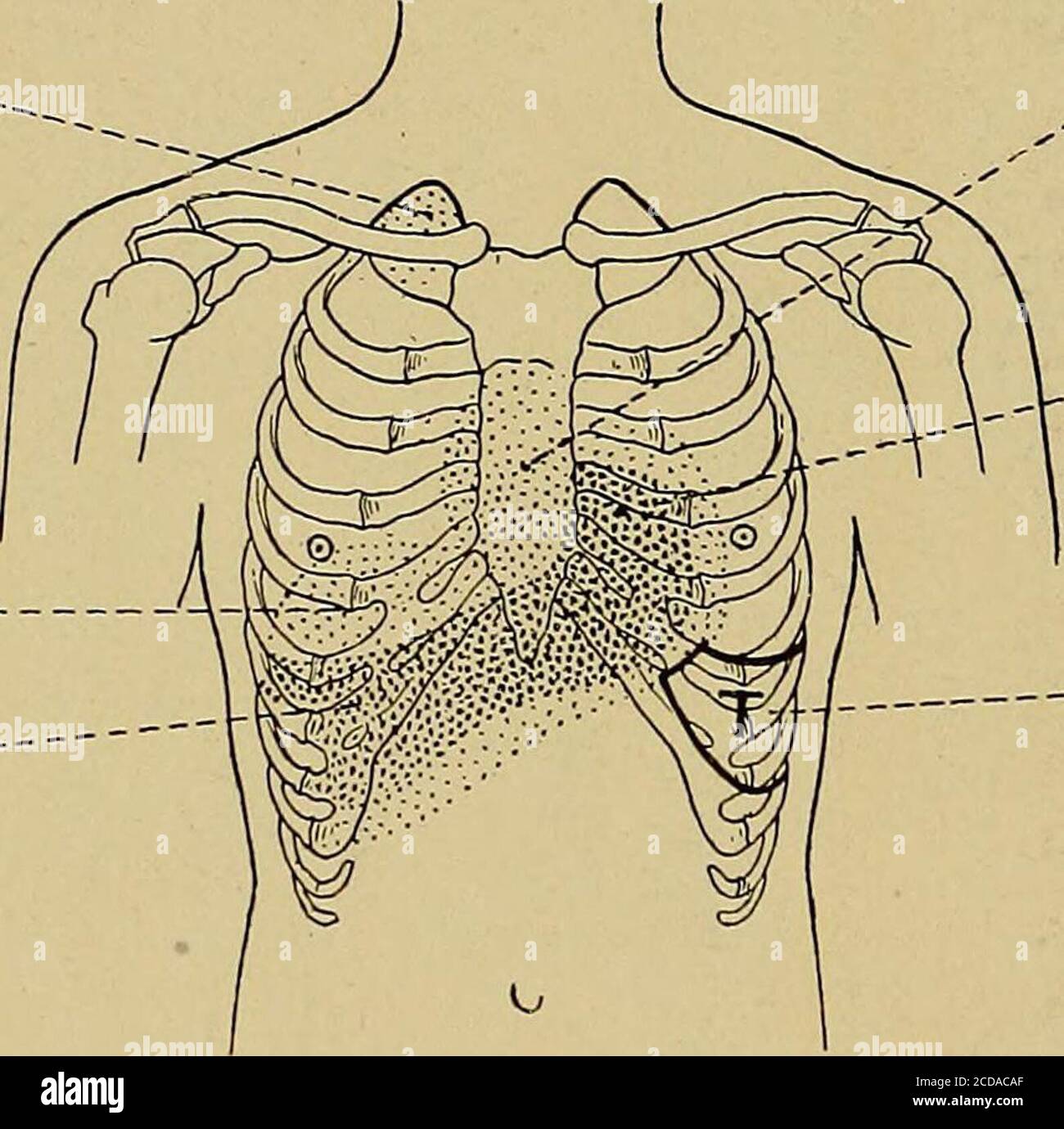 . Physical diagnosis . semilunar tympanitic space. Liver flatness. Fig. 103.—Percussion Outlines in the Normal Chest. II. Percussion Resonance of the Normal Chest. The note obtained by percussing the normal chest varies a greatdeal in different areas. In Fig. 103, the parts shaded darkest arethose that normally give least sound when percussed in the mannerdescribed above, while from the lightest areas the loudest and clear-est sound may be elicited. (a) Vesicular Resonance. The sound elicited in the latter areas is known as normal orvesicular resonance, and is due to the presence of a normal a Stock Photo