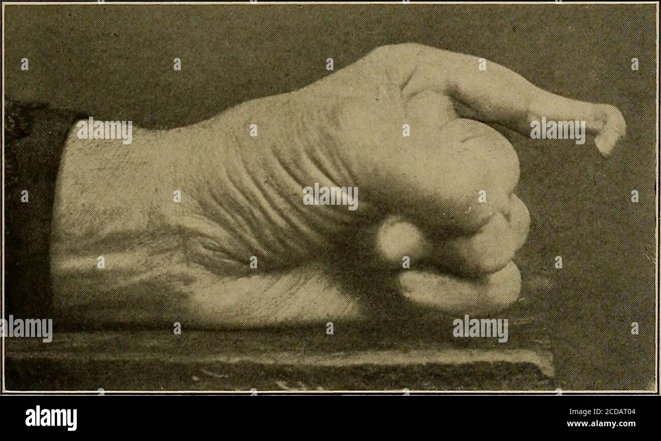 . Physical diagnosis . Fig. 52.—Clubbed Fingers.. Fig. 53.—Raynauds Disease. with double curvation of the nails, lateral and antero-posterior1 (seeFig. 51). In severer forms the bones of the hand and wrist are alsoconsiderably enlarged (see Figs. 39 and 40). 1 Clubbed fingers are occasionally seen in a variety of other diseases: e.g., hepaticabscess, nephritis; and even in apparently healthy persons. 54 PHYSICAL DIAGNOSIS 7. Heberdens nodes, later described under the head of hypertrophicarthritis, are here pictured (Fig. 54). The distinction from gout hasalready been referred to (page 472). 8. Stock Photo