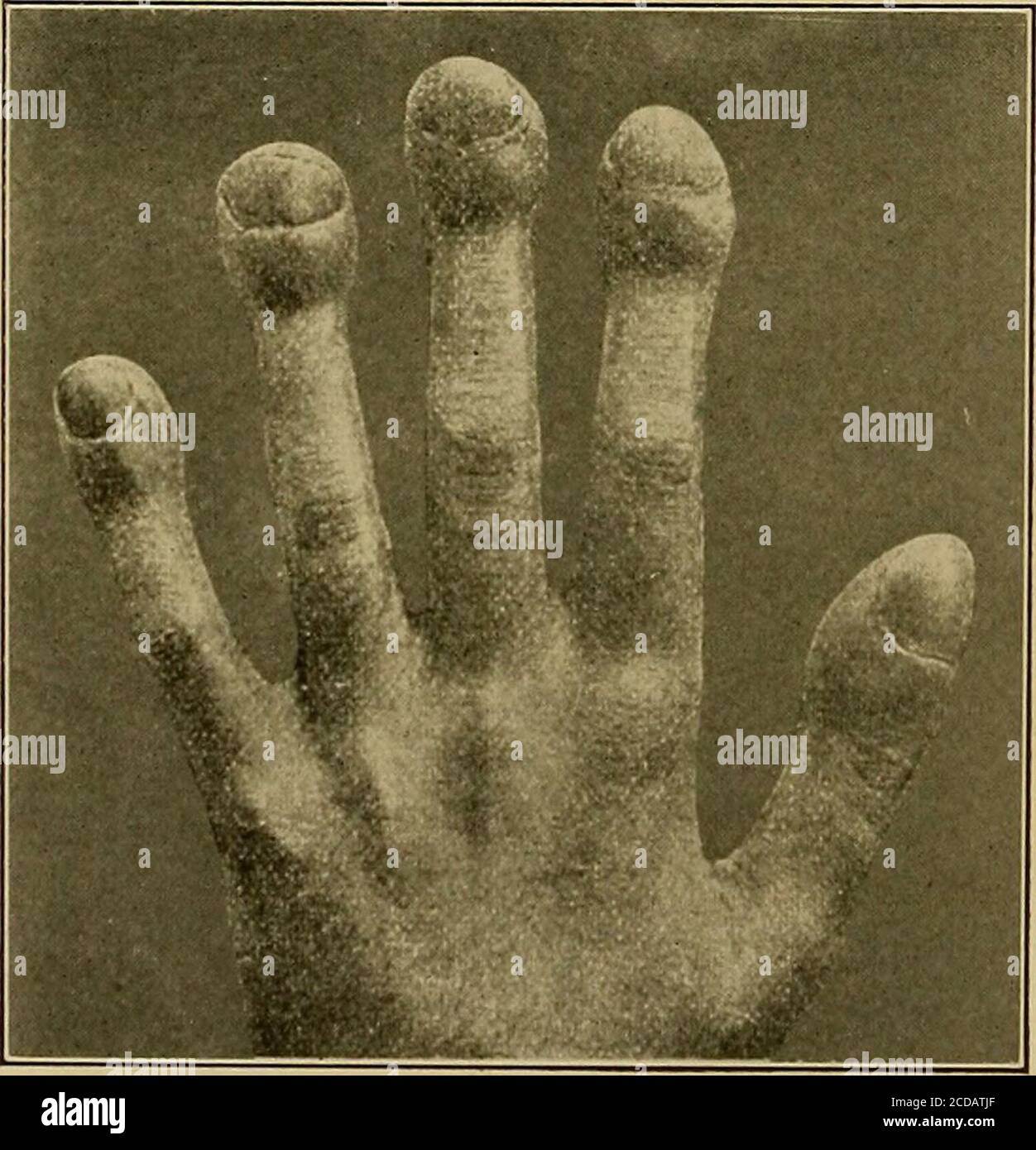 . Physical diagnosis . Fig. 50.—Atrophic Arthritb.. Fig. 51.—Clubbed Fingers. 5. Acromegalia produces general enlargement of the bones andother tissues of the hands and feet. 6. Pulmonary Osteo-arthropathy.—Any long-standing disease of THE HANDS 53 the heart, lungs, or pleura may be followed by this peculiar hyper-trophic change in all the tissues of the extremities. Mild formsproduce clubbed fingers, a bulbous enlargement of the finger-tips Stock Photo